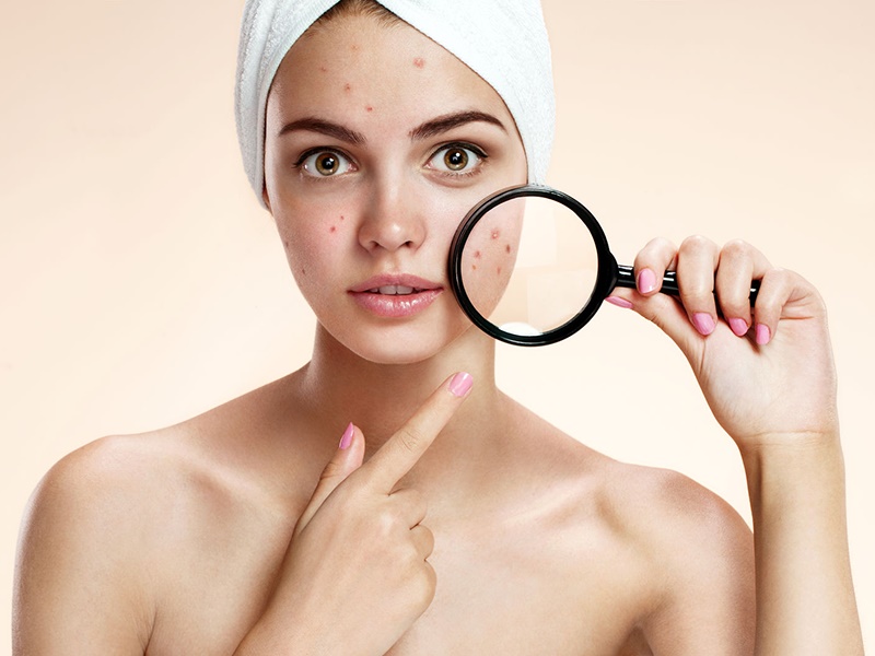 Mụn trứng cá, chăm sóc da