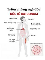 triệu chứng ngộ độc botulism