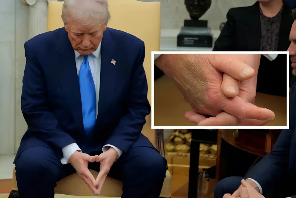 Donald Trump, bàn tay Trump, vết bầm tay phải, sức khỏe Trump, trang điểm Trump, Nhà Trắng